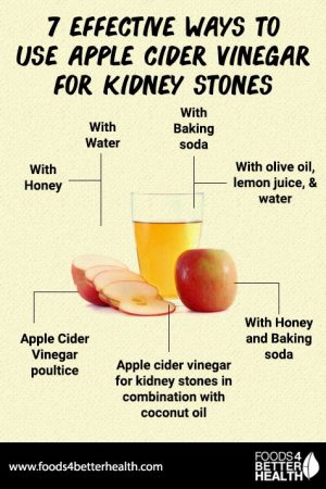 100 apple juice and kidney stones